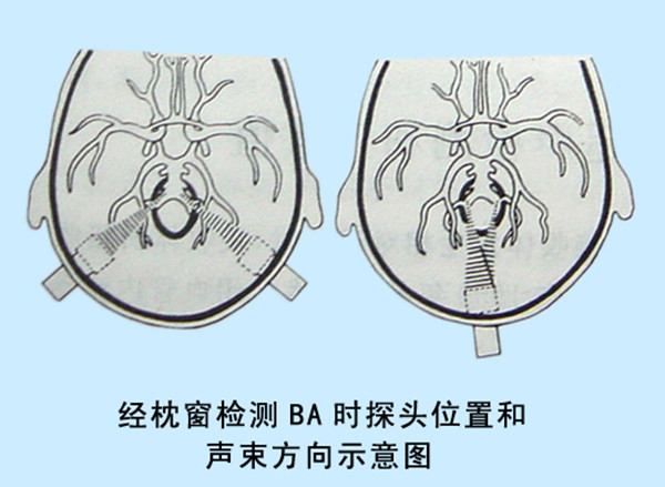 04經(jīng)枕窗檢測(cè)BA時(shí)探頭位置和聲束方向示意圖.jpg