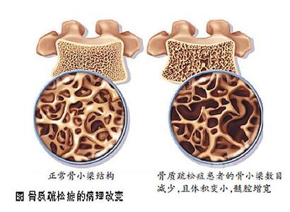 正常與骨質健康問題骨密度對比
